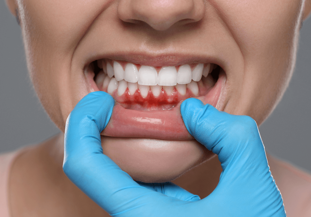 Can Grinding My Teeth Cause My Gums to Recede? 5 Warning Signs to Watch For