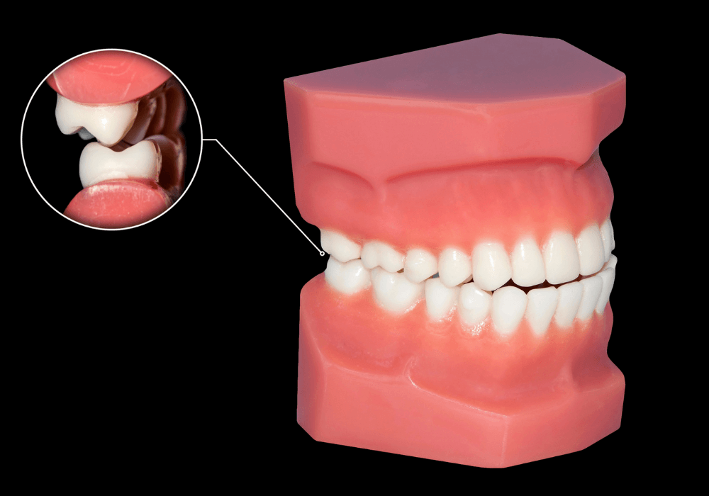 What Is Tooth Grinding? Causes, Dangers, and How to Stop It at Night ...